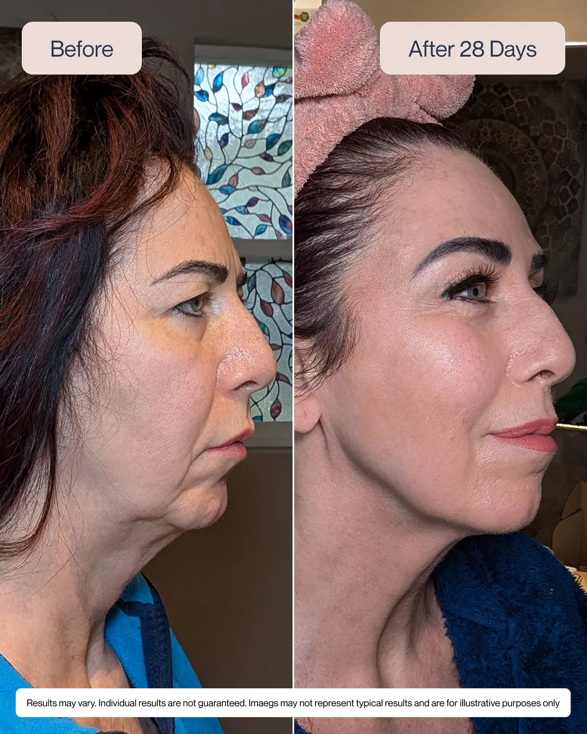 Vertical Lip Line Smoothing Device with Targeted EMS Technology